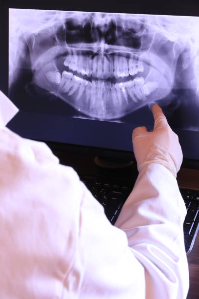 Best Emergency Wisdom Teeth Removal in Bear Valley Springs, CA