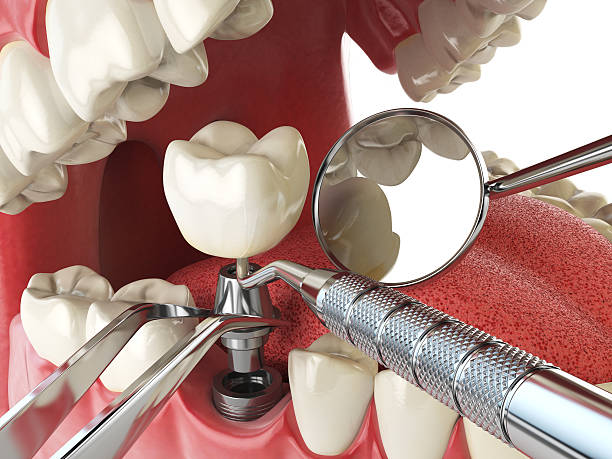Best Emergency Treatment for Dental Infections or Abscesses in Bear Valley Springs, CA